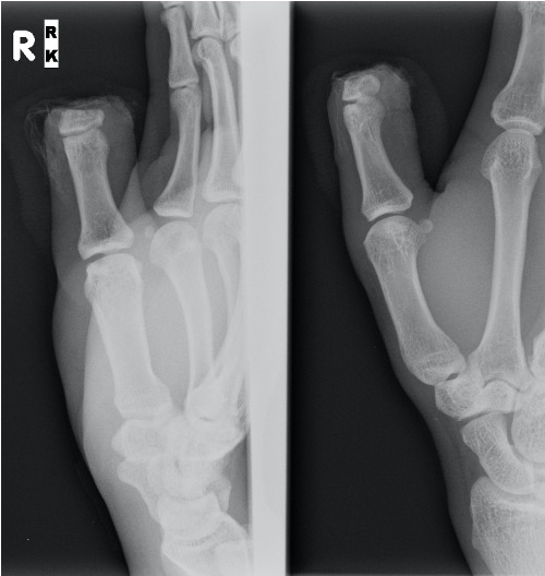 Thumb detip xray