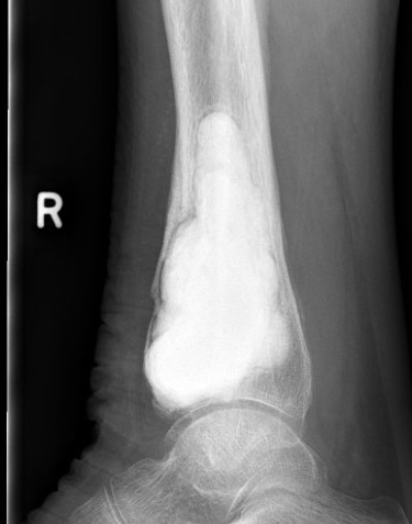 Tibia GCT 1