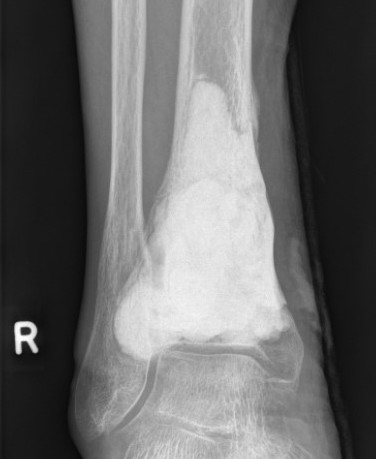 Tibia GCT 2