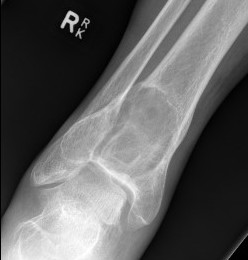 GCT distal tibia