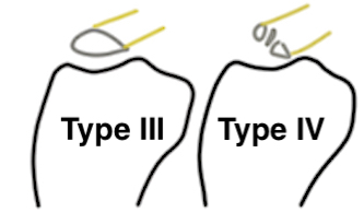 Tibial spine 2