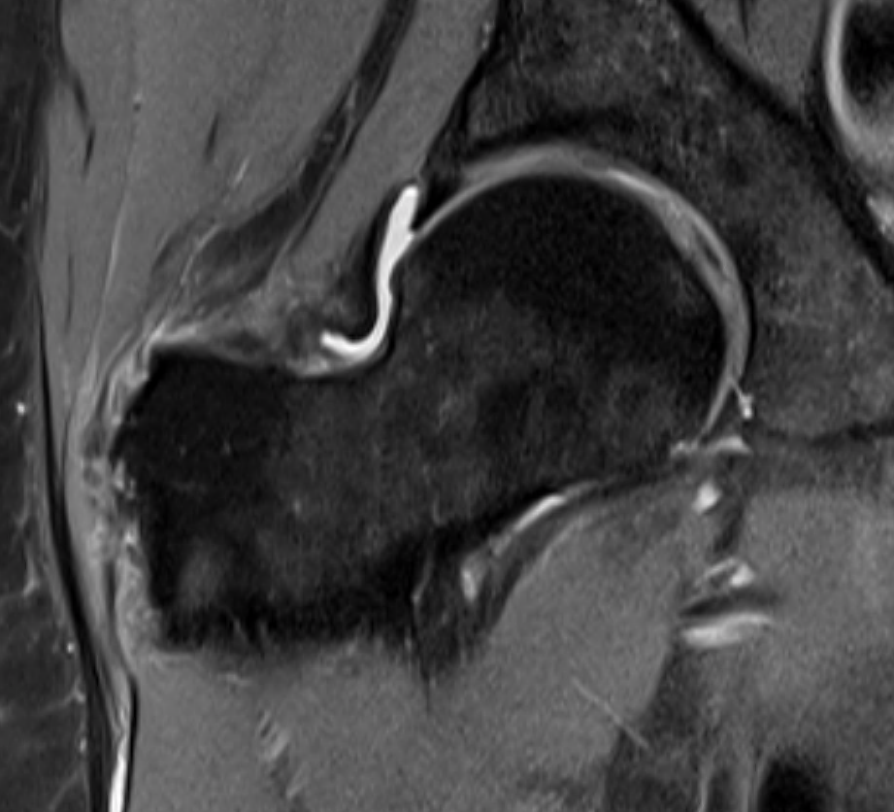 Torn abductors MRI 2