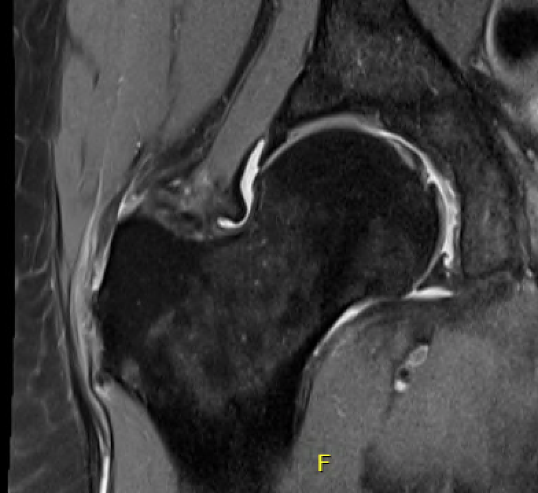 Torn abductors MRI