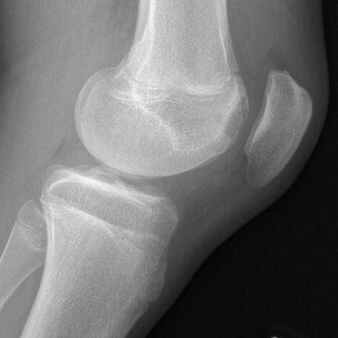 Trochlea OCD xray