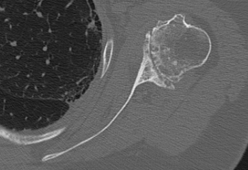 Type A2 glenoid