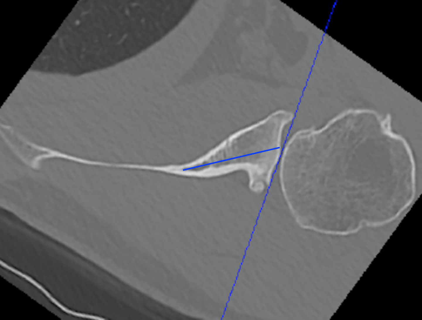 Glenoid vault version measurement