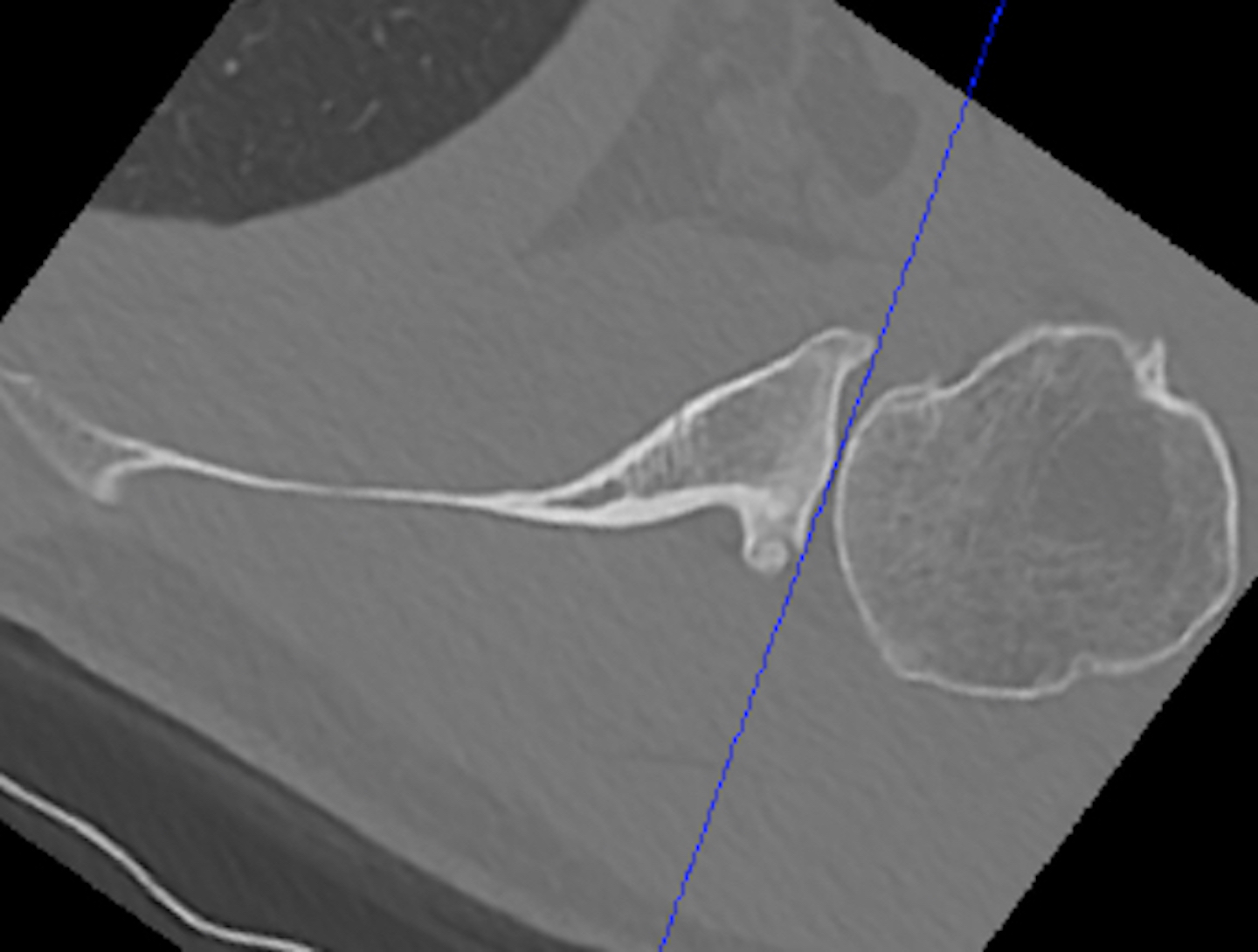 Type B2 glenoid