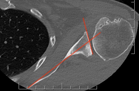 Scapula body method glenoid version