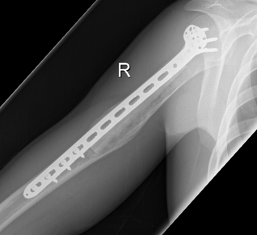 UBC humerus fibular strut 2