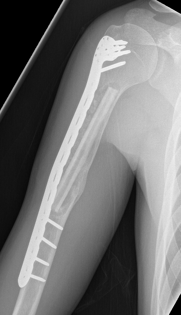 UBC humerus fibular strut 1