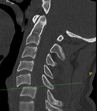 Uni facet Sagittal CT