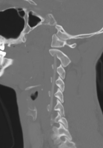 Vertebral artery 2