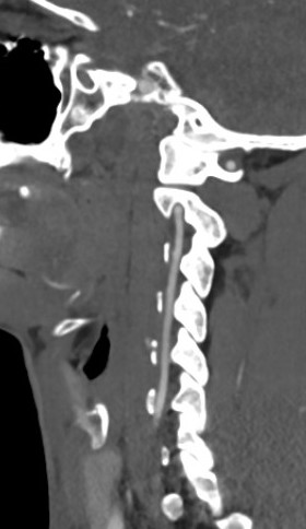 Vertebral artery 3