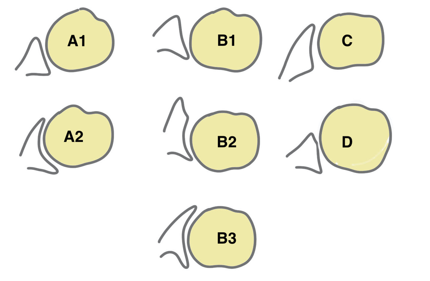 Walch Glenoid Morphology Classfication