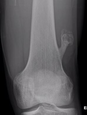 Osteochondroma