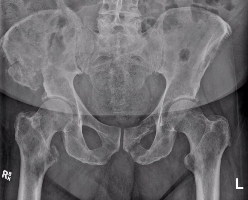 Myeloma pelvis