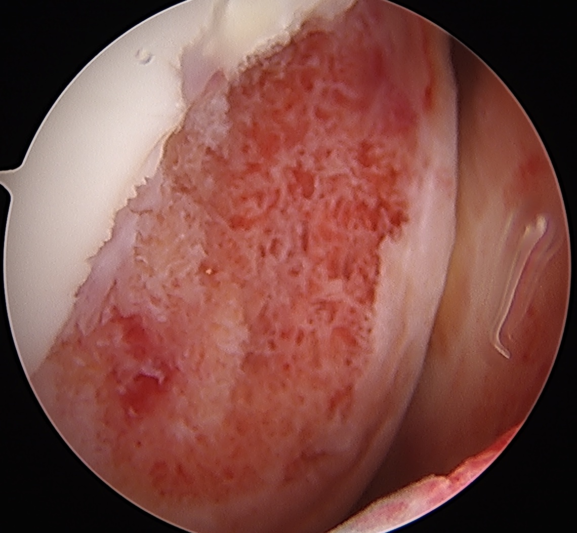 Grade IV cartilage