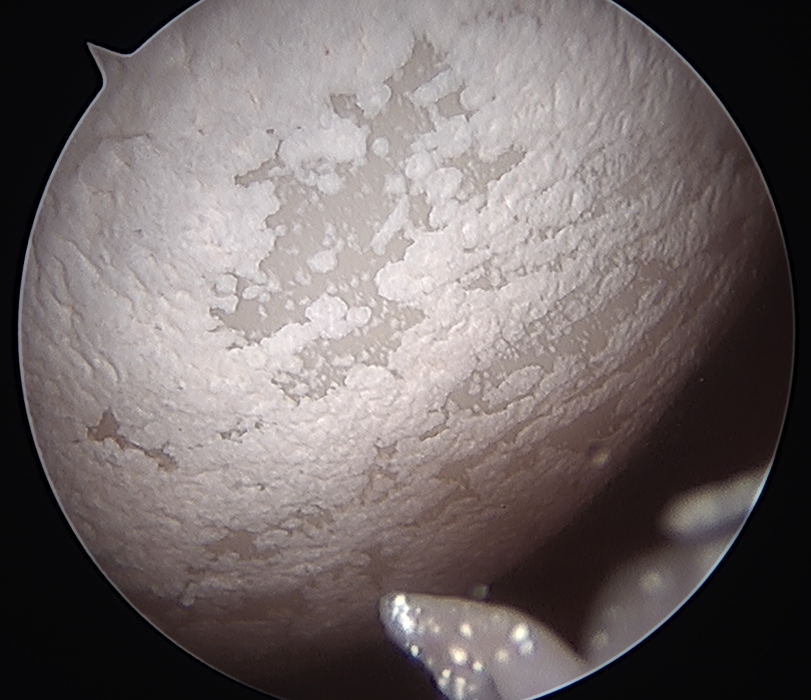 Chondrocalcinosis knee 1