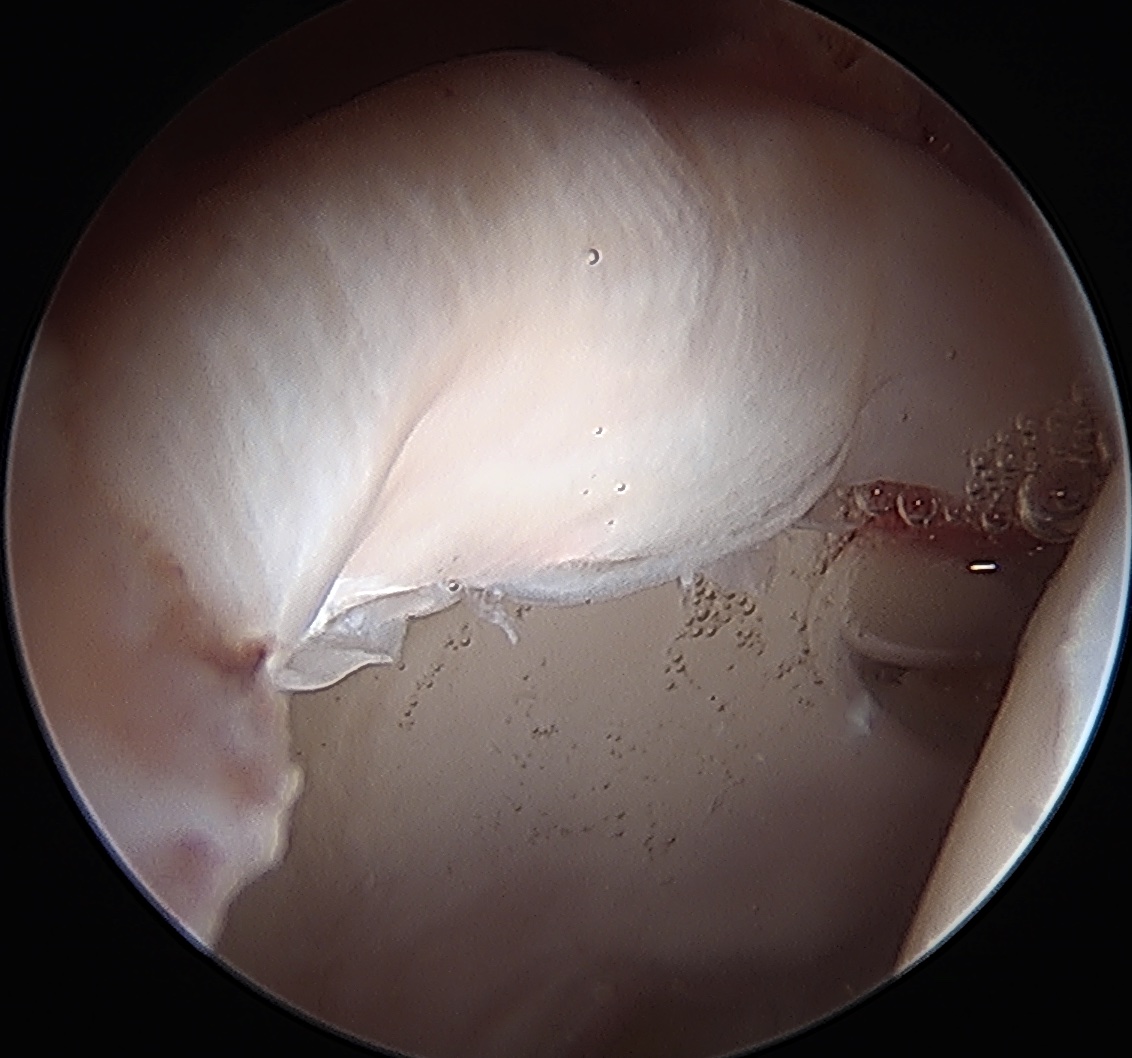 Labral tear