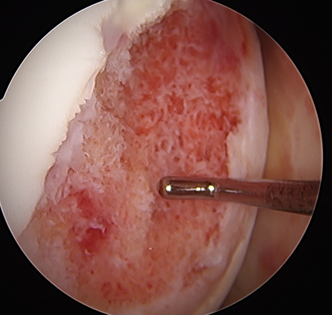 Chondral defect sizing