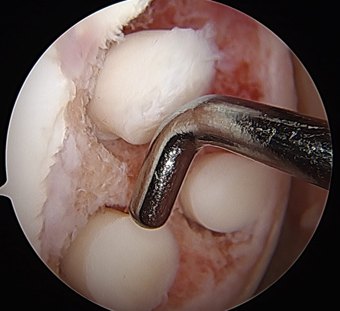 Chondral defect mosaciplasty