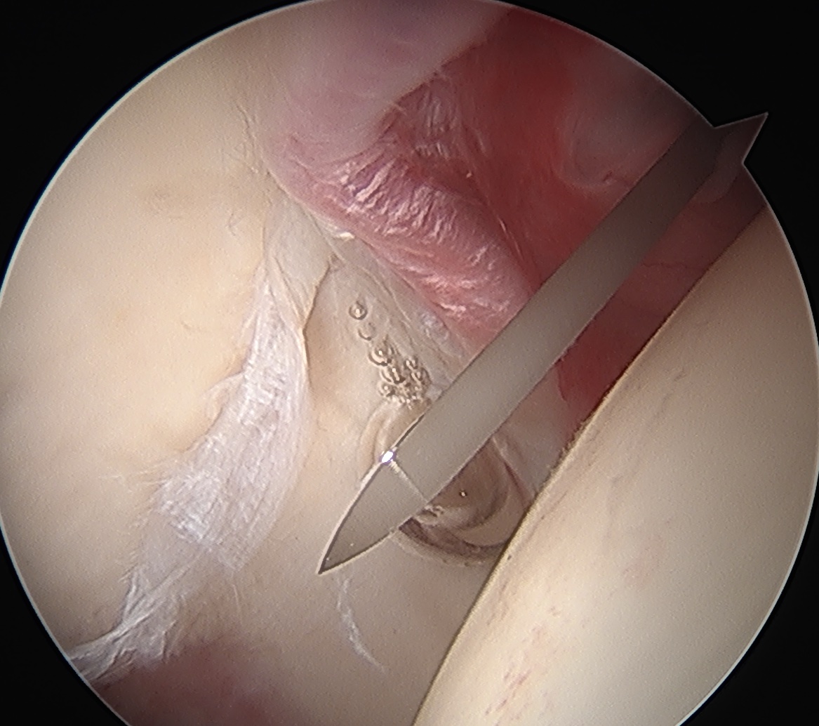 Interportal capsulotomy 2