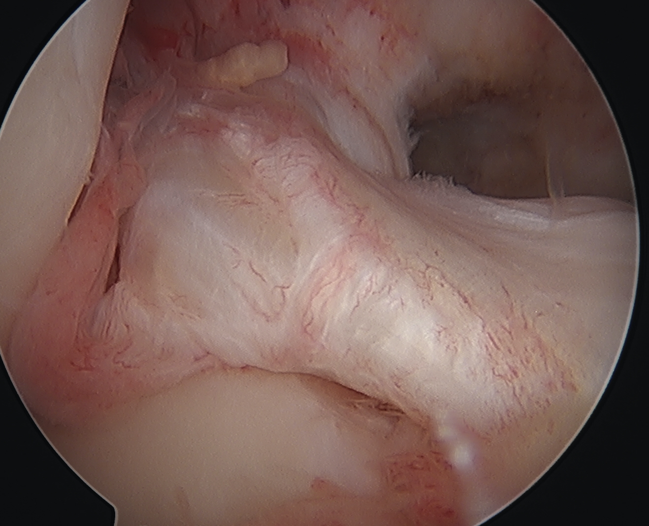 ACL laxity due to PCL tear 2