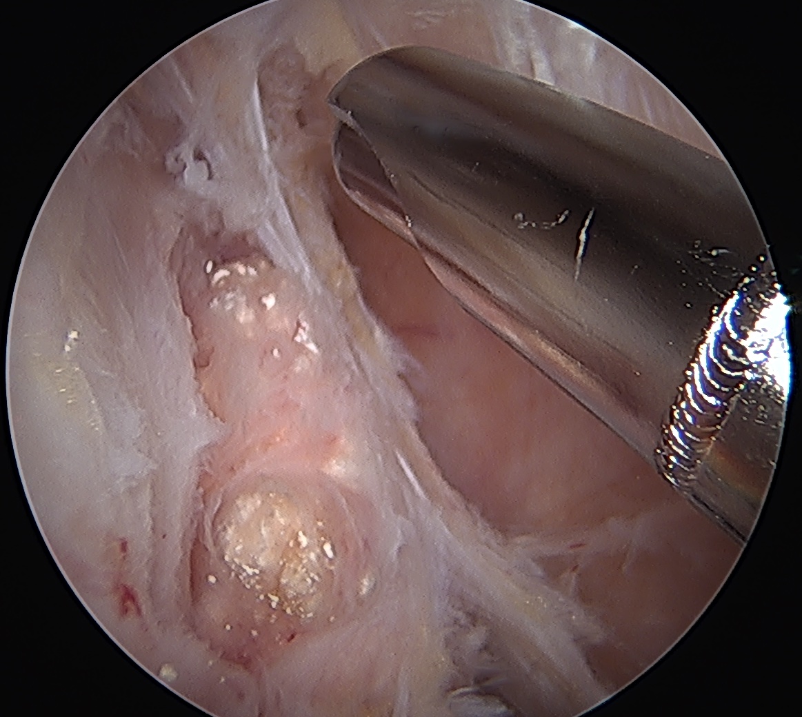 Chondrocalcinosis knee 3