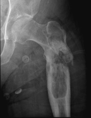 Pathological fractures CS