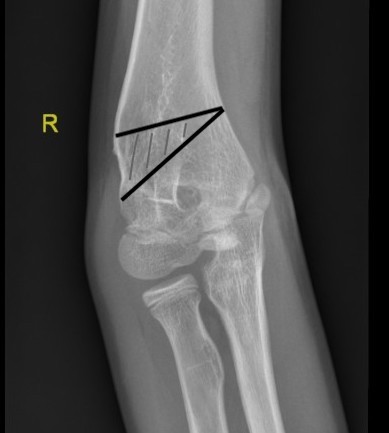 Corrective osteotomy 2