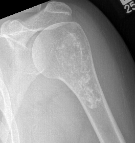 Enchondroma shoulder 1