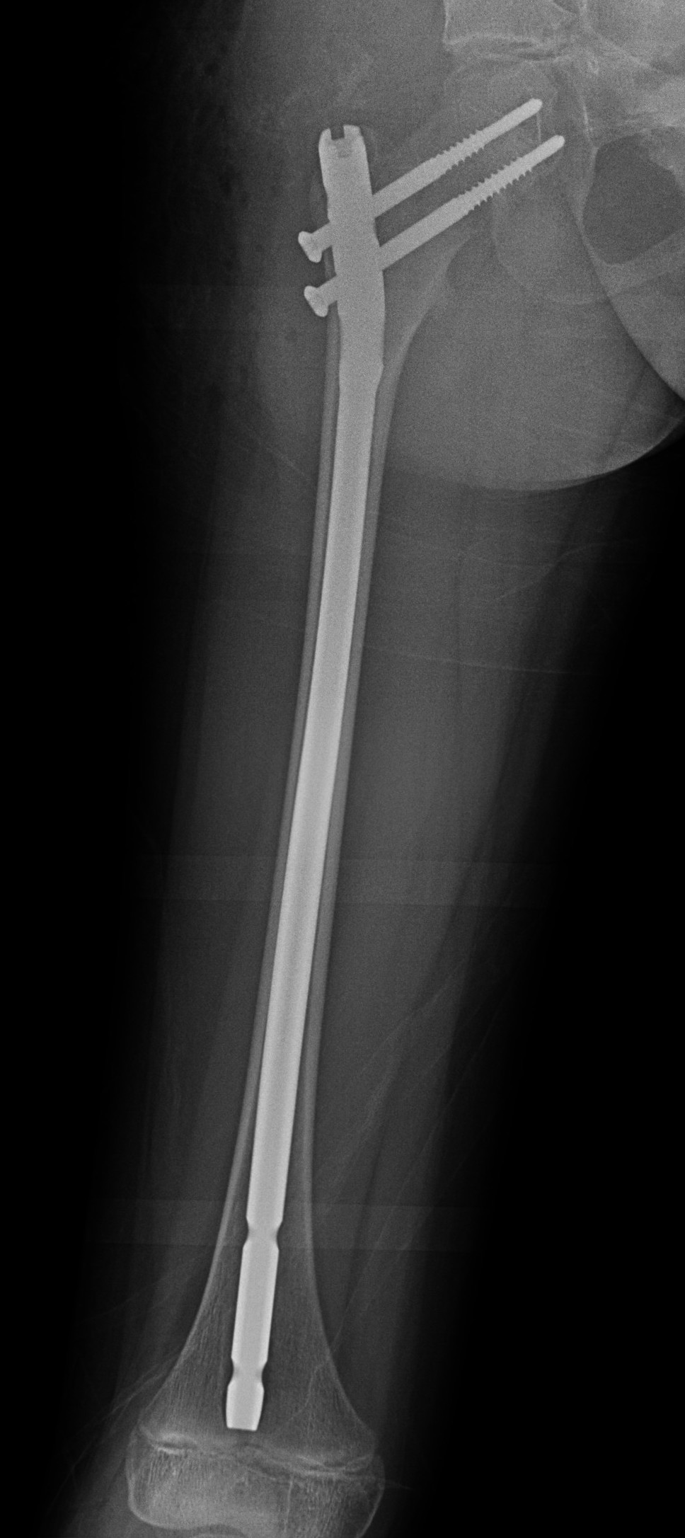 FD femur 2