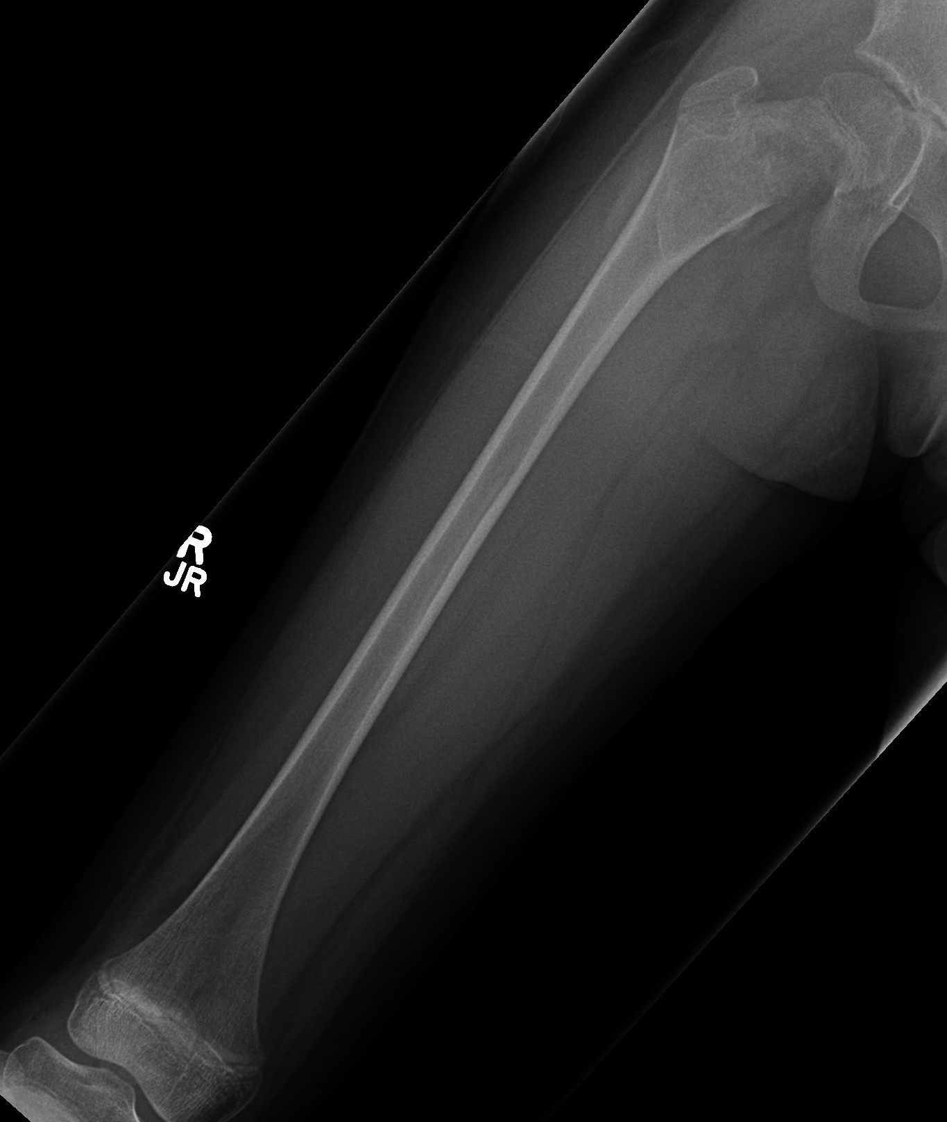 FD Femur 1