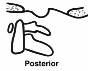 Atlanto occipital dislocation posterior