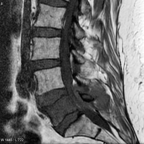 vert lymphoma 2