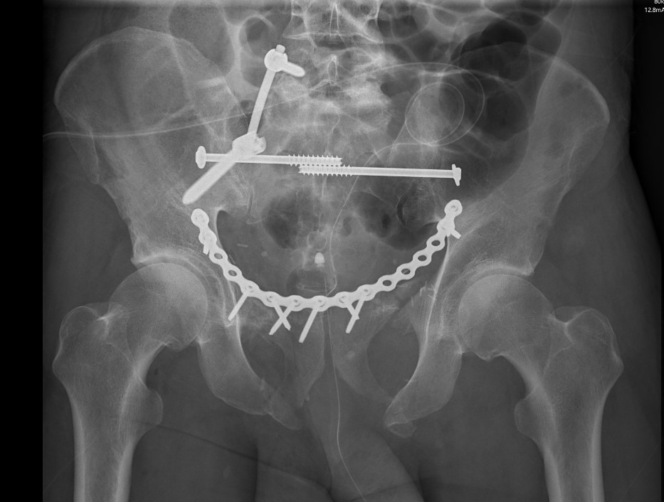 Bilateral pubic rami plate