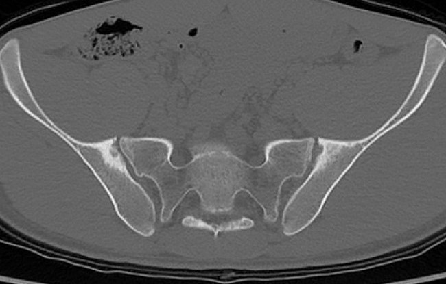 Sacroilitis