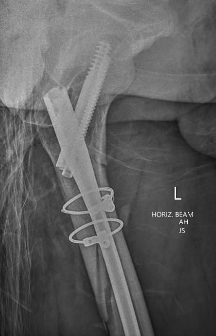 Subtroch cerclage