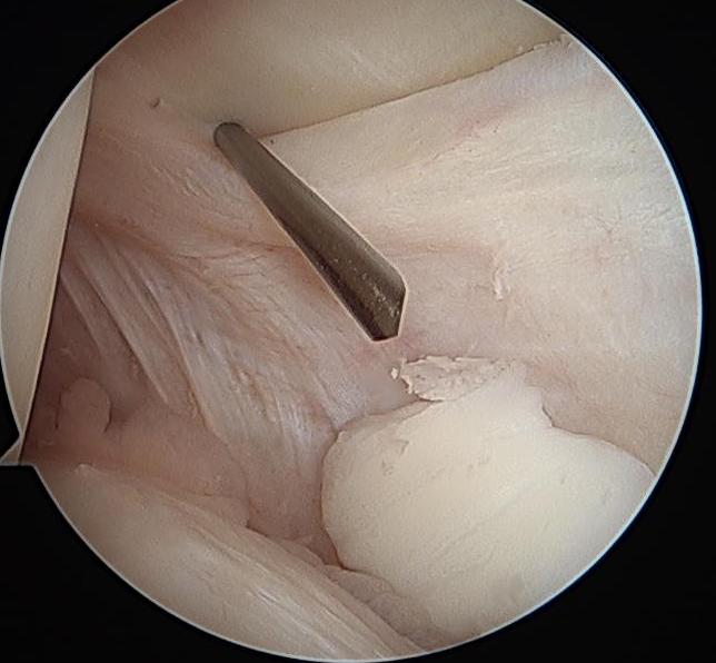 Posteromedial portal 2