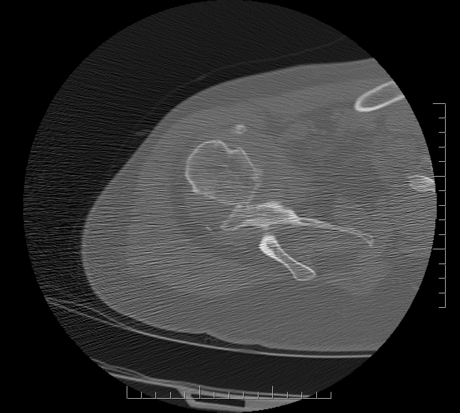 Chronic Anterior Dislocation